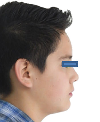 Fig.17 Perfil