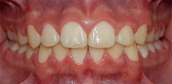 Figura 18 Intraoral de frente