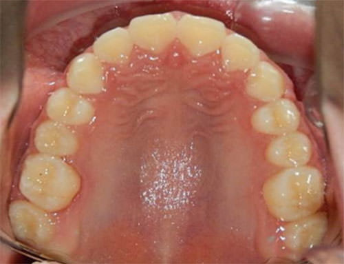 Fig. 21 Oclusal superior