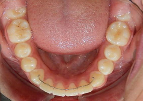 Fig 22 Oclusal inferior