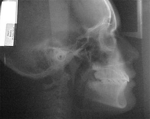Fig. 23 Radiografía lateral de cráneo