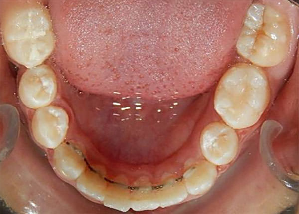 Figura19 Oclusal Inferior