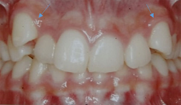 Figura 3 Intraoral de frente