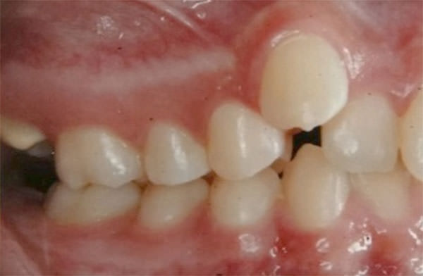 Figura 4 Intraoral derecho