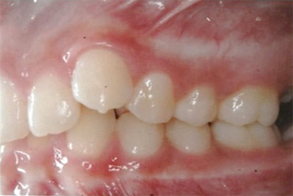 Figura 5 Intraoral lado izquierdo