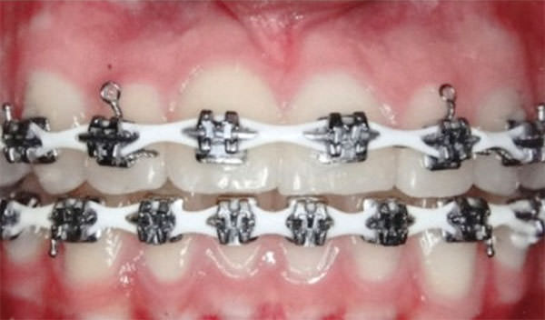 Figura 8 Intraoral de frente de progreso