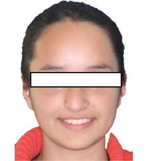 Figura 10 Frente sonrisa final