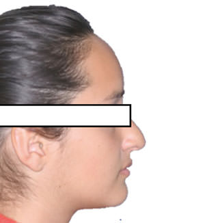 Figura 11 Lateral final