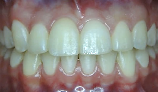 Figura 12 Intraoral de frente final