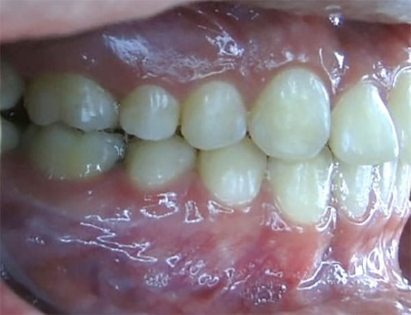 Figura 13 Intraoral derecha final