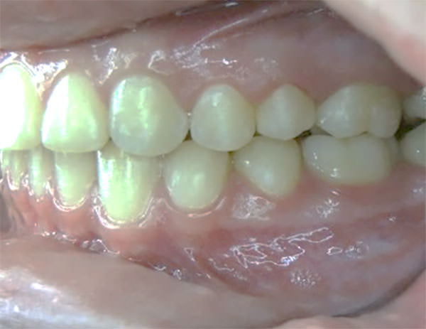 Figura 14 Intraoral izquierda