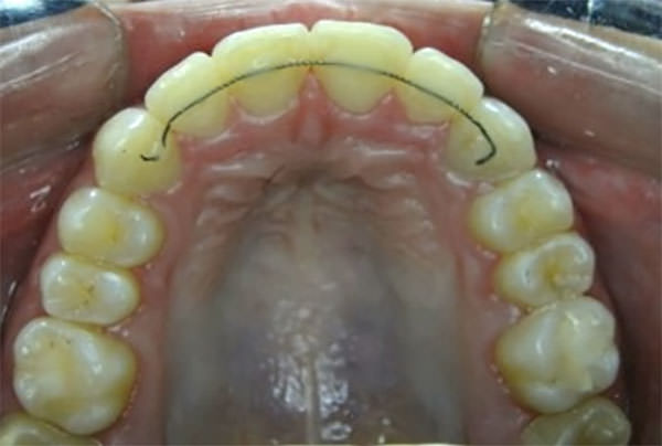 Figura 15 Oclusal superior final