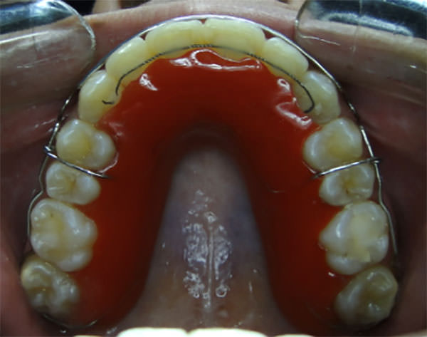 Figura 17 Oclusal superior, retenedor circunferencial