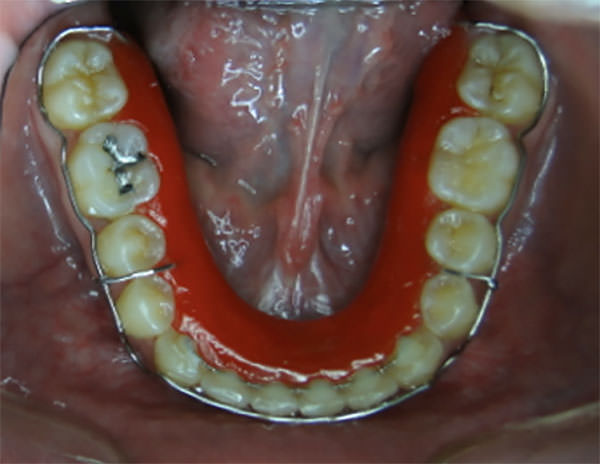 Figura 18 Oclusal inferior, con retenedor