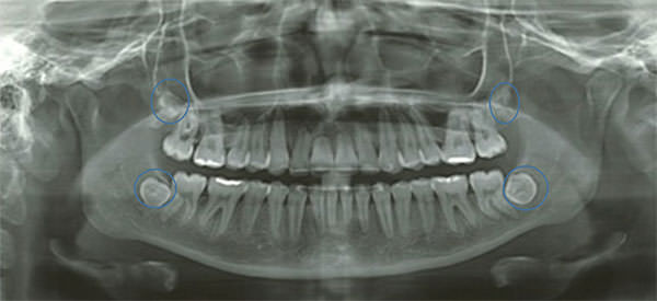 Fig.19 Rx. Panorámica
