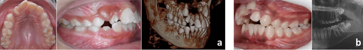 Figura 10. Supernumerarios. (a) Vestibular a UD 12. (b) Vestibular a UD 27. Fuente: Postgrado de Ortopedia Dentofacial y Ortodoncia UC