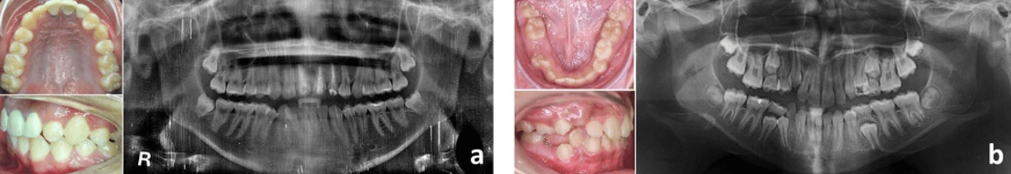 Figura 11. Transposiciones. (a) UD 23-24. (b) UD 42-43. Fuente: Postgrado de Ortopedia Dentofacial y Ortodoncia UC