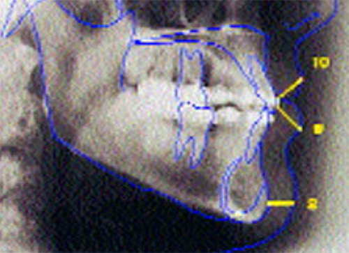 Figs 1 CAMBIOS EN EL PERFIL DE TEJIDOS BLANDOS. A.- Pretratamiento. B.- Post tramiento. Fuente: Revista Gaceta Dental.