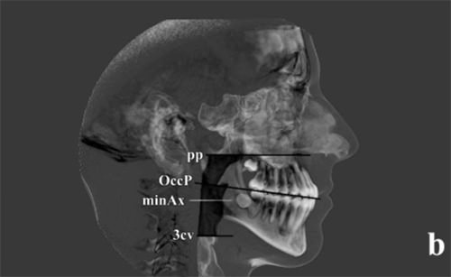 Fig 3 CAMBIOS EN LAS VIAS AEREAS SUPERIORES A.- Visión tridimentional B.- Visión bidimensional. Fuente: Revista Angle Orthodontics.