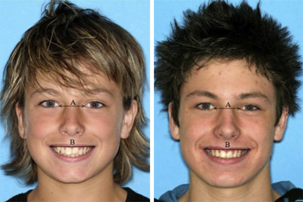 Fig 4 CAMBIOS EN SONRISA A.- Pre tratamiento B.- Post tratamiento Fuente: Revista AJO-DO.