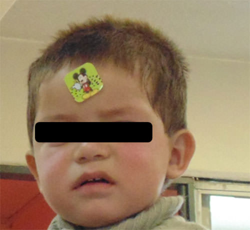 Fig.1 Paciente masculino de 3 años de edad, mesocefálico, presenta dermatitis atópica por alergia al sol.