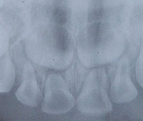 Fig.2 Zonas radiolúcidas pequeñas, circunscritas localizadas en la zona apical de los órganos dentarios 51 y 61. Además de presentar ligero engrosamiento del ligamento periodontal.
