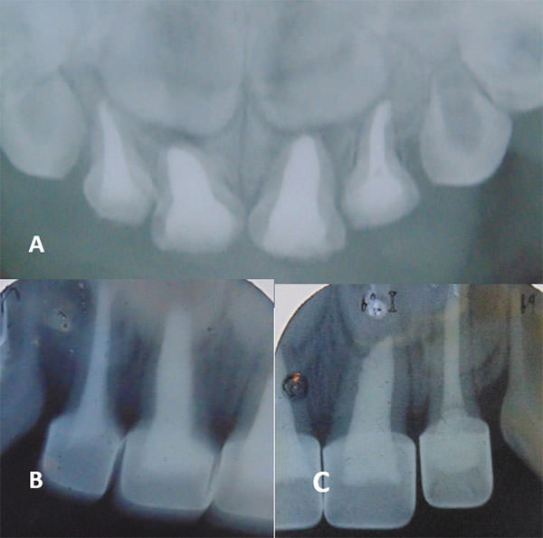 Fig.3 A.Radiografía oclusal donde se observa el tratamiento pulpar (pulpectomía) de los órganos dentarios 51, 52, 61 y 62. B. radiografía periápical de pulpectomía y coronas de níquel cromo en los órganos dentarios 51 y 52. C. Radiografía periápical del pulpectomía y corona de níquel cromo de los órganos dentarios 61 y 62.