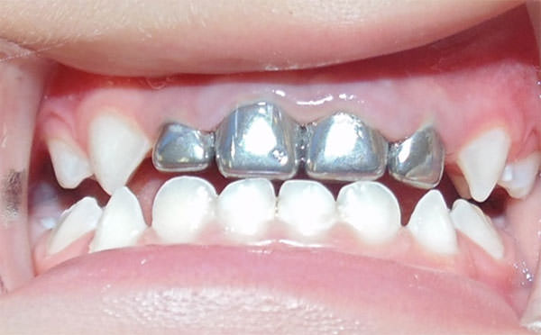 Fig.5 Fotografía de máxima intercuspidación en la que se observan coronas níquel cromo en los órganos dentarios 52, 51, 61 y 62.