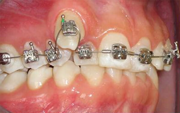 BracketCarriere LX