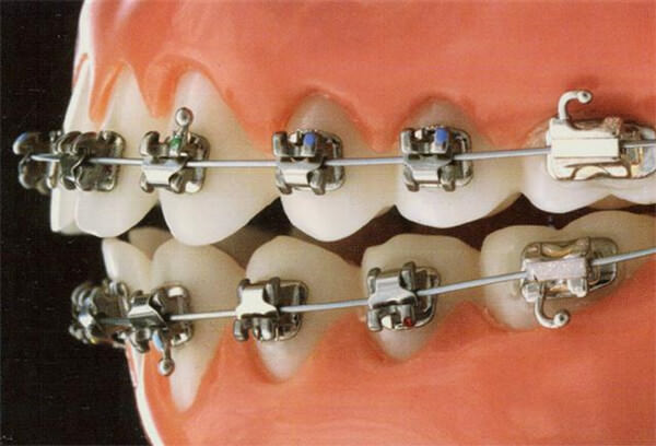 Bracket In- Ovation