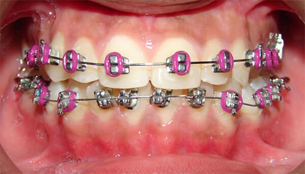 Brackets QR