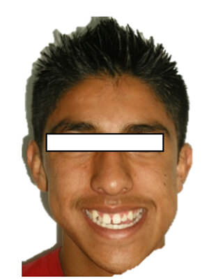 Figura 2 Frente sonrisa