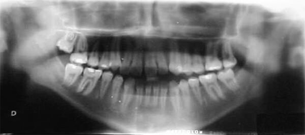 Figura 8 Radiografía panoramica.