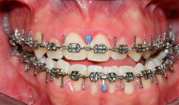 Figura 9 Intraoral de frente