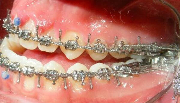 Figura 11 Intraoral izquierda