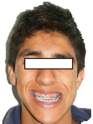 Figura 15 Sonrisa