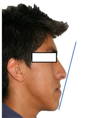 Figura 16 Perfil derecho