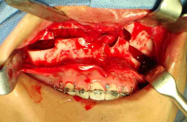 Figura 17 Intraoral de frente, corte Lefort I