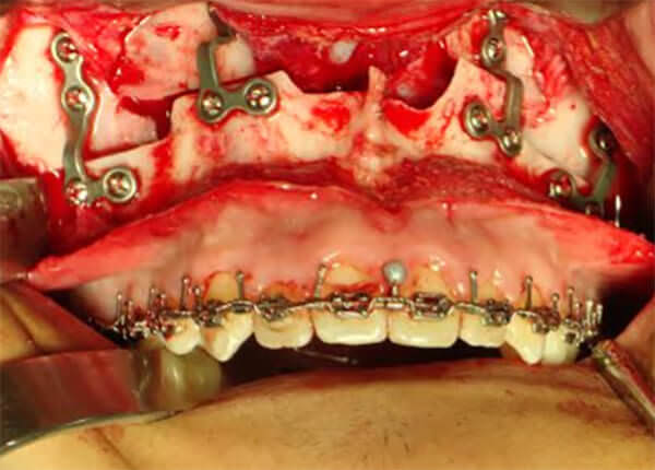 Figura 18 Intraoral de frente, fijación rígida.