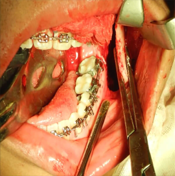 Figura 19 Intraoral