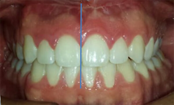 Figura 22 Intraoral de frente