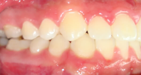 Figura 23 Intraoral derecha