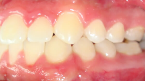 Figura 24 Intraoral izquierda