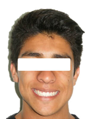 Figura 26 Sonrisa
