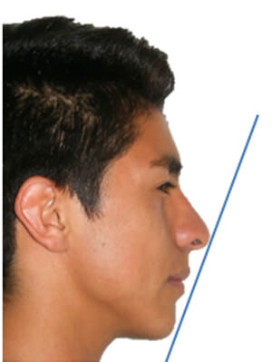 Figura 27 Perfil derecho