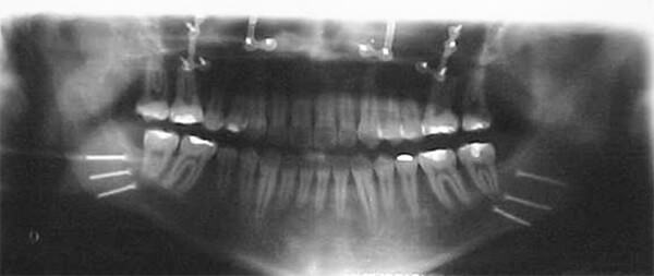 Figura 29 Radiografía panorámica