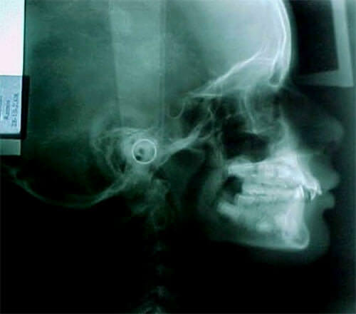 Fig. 1 Radiografia lateral de craneo