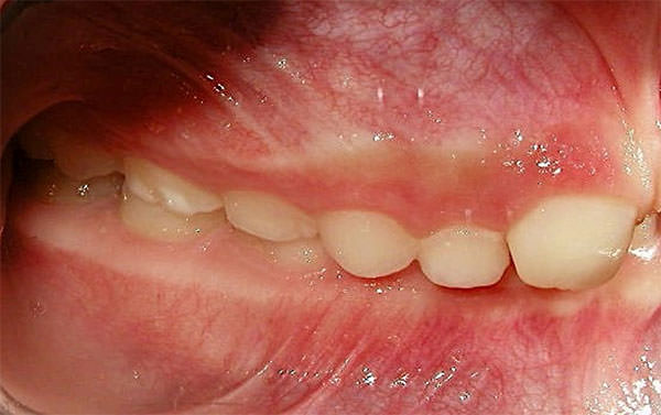 Fig. 3 Lateral derecha