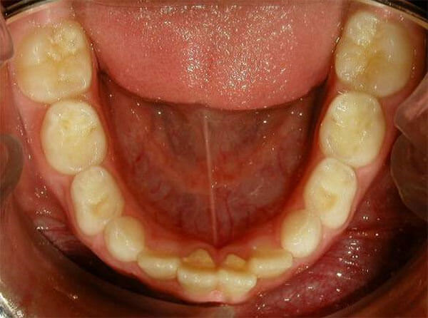 Fig. 7 Oclusal inferior