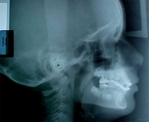 Fig. 8 Rx. lateral de cráneo